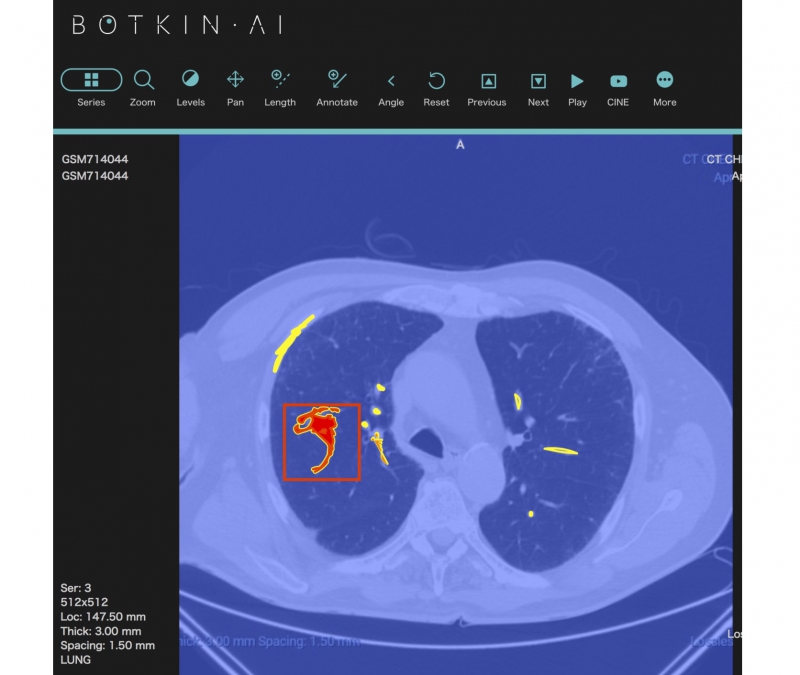 Автоматический анализ изображений КТ, МРТ, маммографии и цифрового рентгена. Источник: botkin.ai