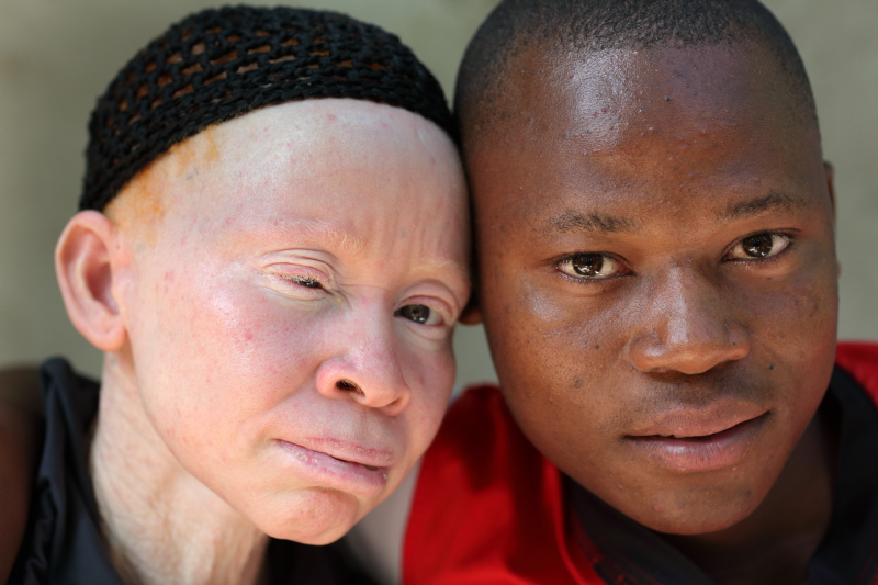 Женщина с альбинизмом и ее сын. Источник: depositphotos.com
