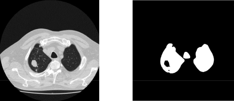 Пример снимка КТ легких с новообразованием: до сегментации изображения с помощью метода водоразделов (слева) и после (справа). Изображения предоставлены авторами работы
