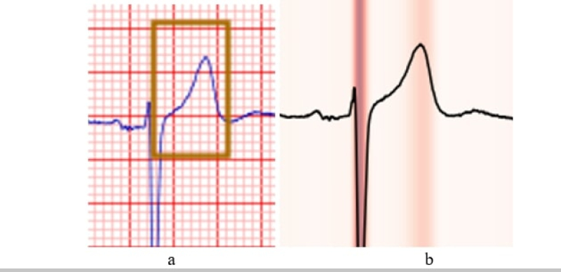 Как ищут признаки инфаркта врач (слева) и модель (справа). ​Фото предосталено учеными
