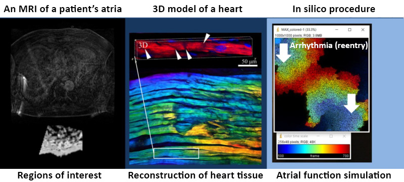 There are three stages in the process. First, the neural network segments MRI data and determines the structure of the atria to separate fibrous and healthy cells. Afterward, the algorithm distributes the cells in accordance with the fibrosis pattern utilizing the method of parameterization and creates a digital twin of the heart. Finally, it models several surgical protocols from which medical specialists can select the best. Credit: AIP Publishing
