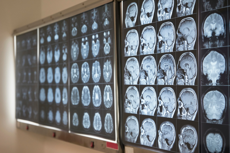 MRI brain scans. Credit:&nbsp;srikijt / photogenica.ru
